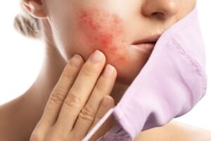 Rosacea treatment